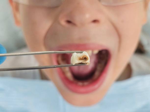 Best Broken or Cracked Tooth Emergency Dentist in Wauseon, OH